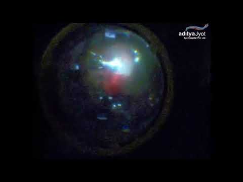 Surgery For Pellet Eye Injury In Conflict Torn Kashmir – traumatic cataract