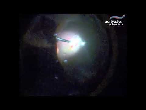 Surgery For Pellet Eye Injury In Conflict Torn Kashmir – repaired corneal tear