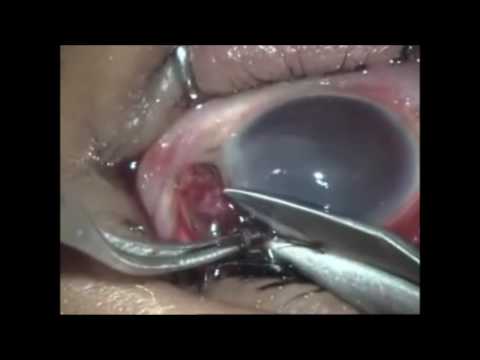 OG Debridement