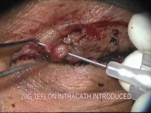 Canalicular Repair