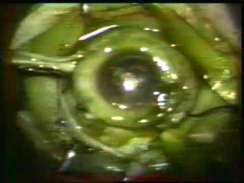 Unusual IOFB – Bullet