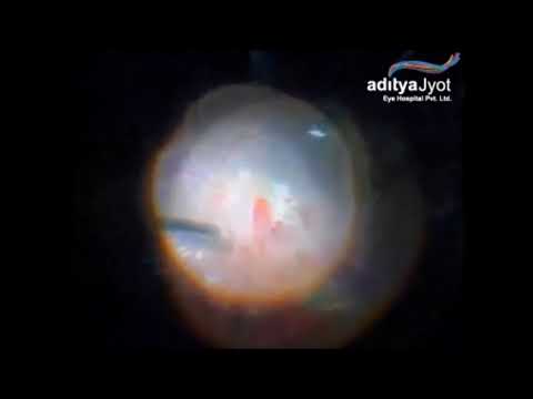 Surgery For Pellet Eye Injury In Conflict Torn Kashmir – traumatic retinal detachment