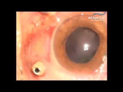 Surgery For Pellet Eye Injury In Conflict Torn Kashmir – vitreous hemorrhage