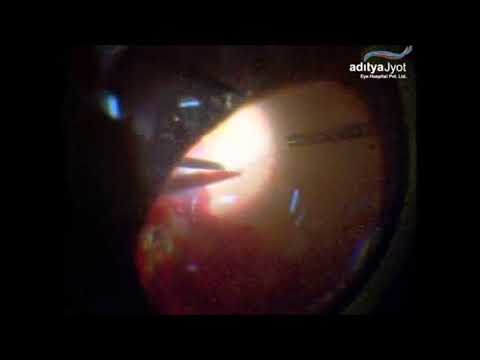 Surgery For Pellet Eye Injury In Conflict Torn Kashmir – traumatic retinal break