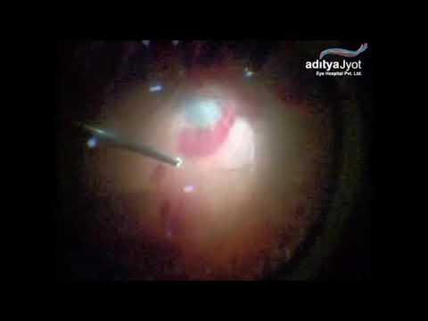 Surgery For Pellet Eye Injury In Conflict Torn Kashmir – retinal detachment (1)